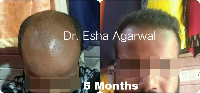 Hair Transplant Results, Hair Transplant Before After Photos Ghaziabad
