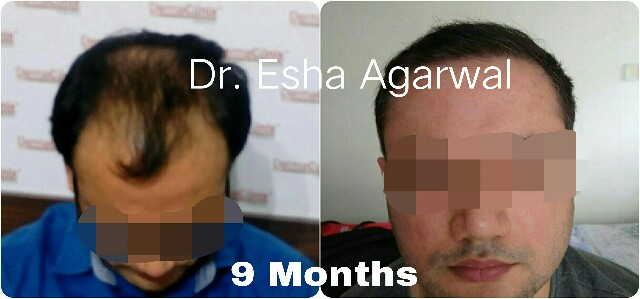 Hair Transplant Results, Hair Transplant Before After Photos Ghaziabad