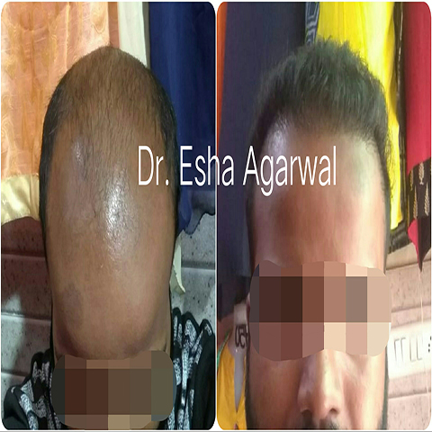 best hair transplant before after Ghaziabad