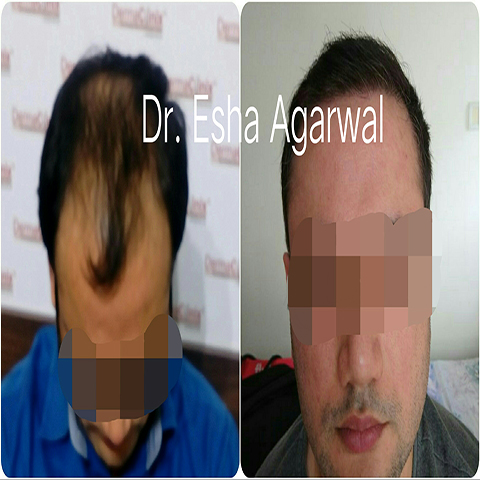 hair transplant results Ghaziabad